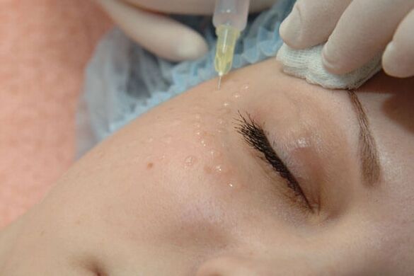 Mesotherapy - kaedah suntikan peremajaan kulit muka
