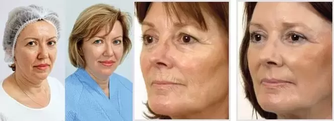 Hasil peremajaan kulit muka dengan laser adalah pengurangan kedutan
