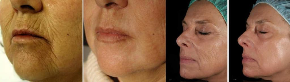 Kulit muka sebelum dan selepas prosedur peremajaan laser