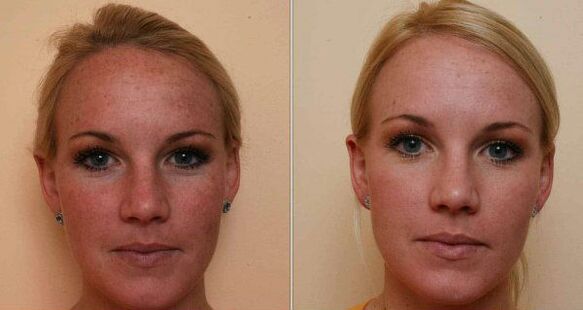 sebelum dan selepas peremajaan kulit wajah laser