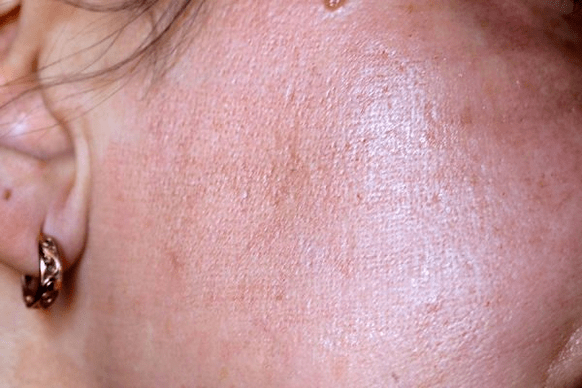 kemerahan kulit selepas peremajaan laser