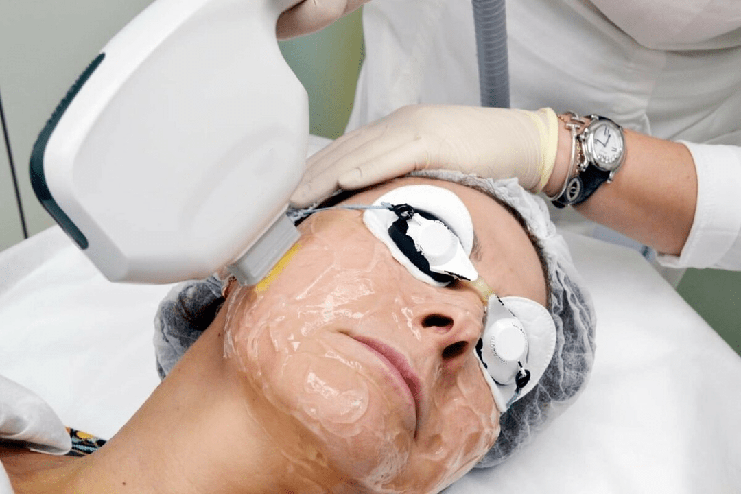 peremajaan laser untuk kulit wajah