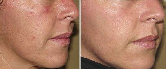 wajah sebelum dan selepas peremajaan kulit perkakasan